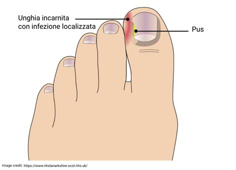 Unghia incarnita su alluce