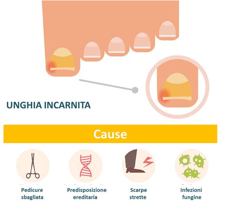 Schema delle cause di unghia incarnita