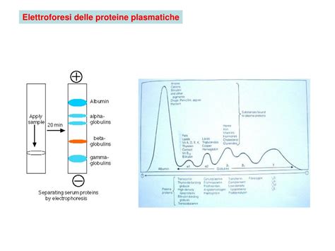 Elettroforesi delle proteine del liquor con bande oligoclonali