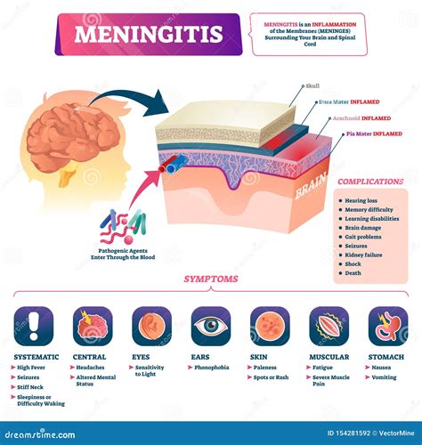 Schema riassuntivo delle differenze tra vari tipi di meningite basato sui parametri del liquor