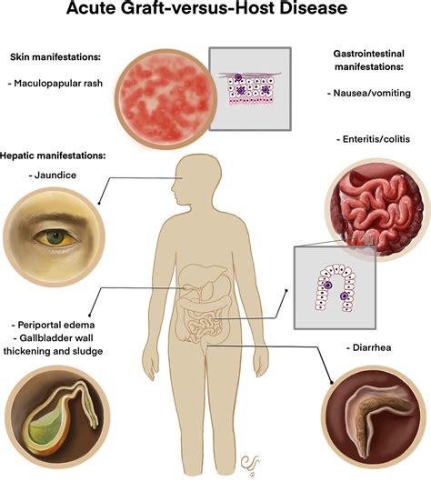 Schema che illustra gli organi colpiti dalla GVHD acuta