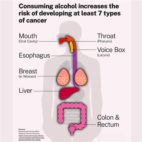 Diagramma che illustra i tipi di tumore associati al consumo di alcol